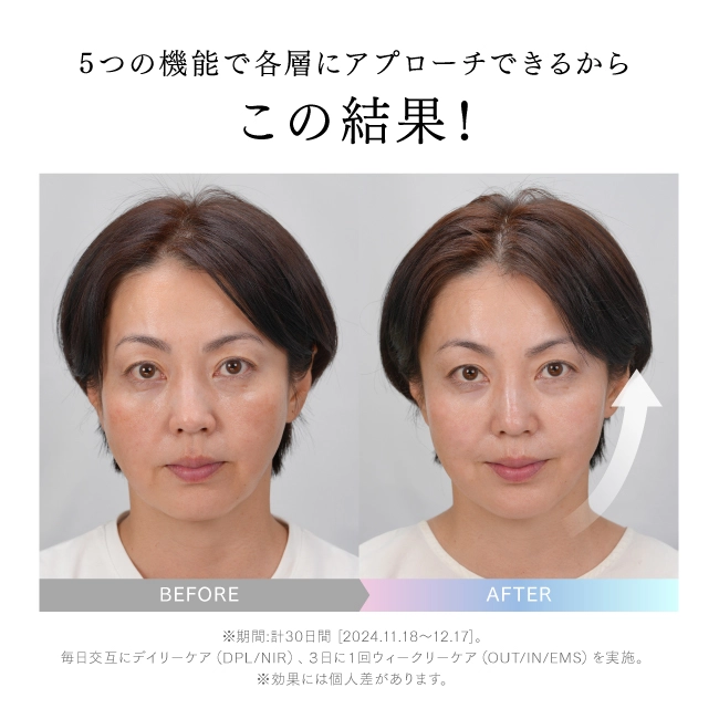 マイトレックスミライワンの30日継続前後の画像比較