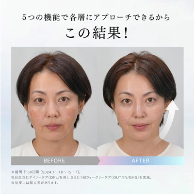 マイトレックスミライワンの30日継続前後の画像比較