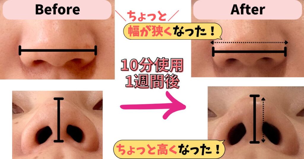 使用1週間後：直後でなくてもちょっと鼻がシュッとしてきた