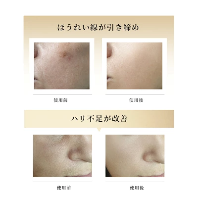 NiZmirのRF多機能美顔器のビフォーアフター画像