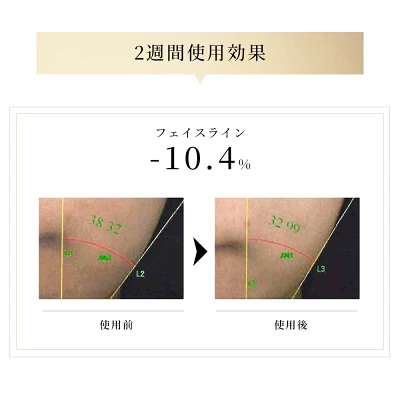 NiZmirのRF多機能美顔器を2週間使用した後のフェイスライン比較